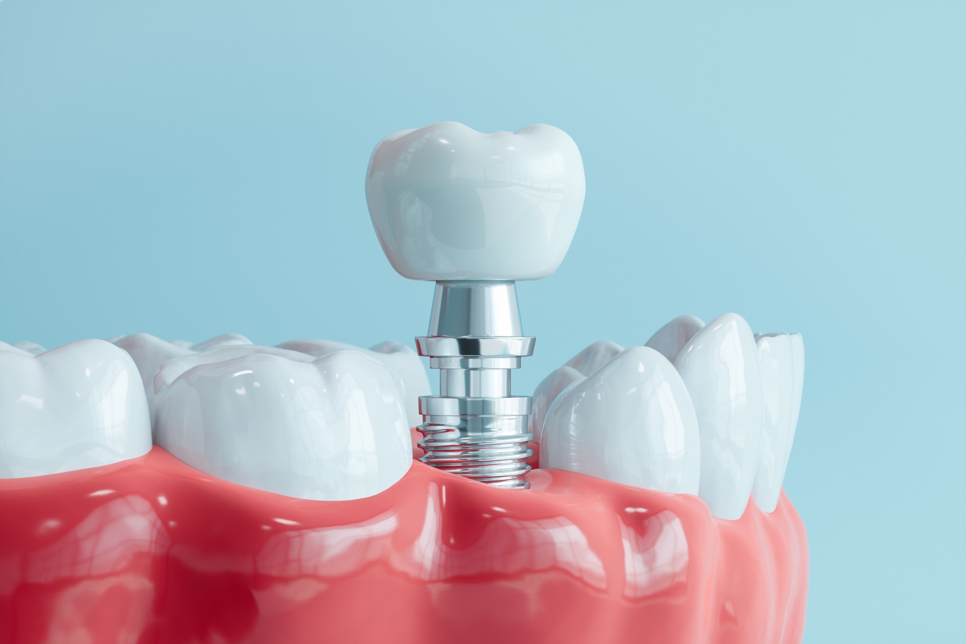 3D Model Of Human Gums And Dental Implant With Blue Background